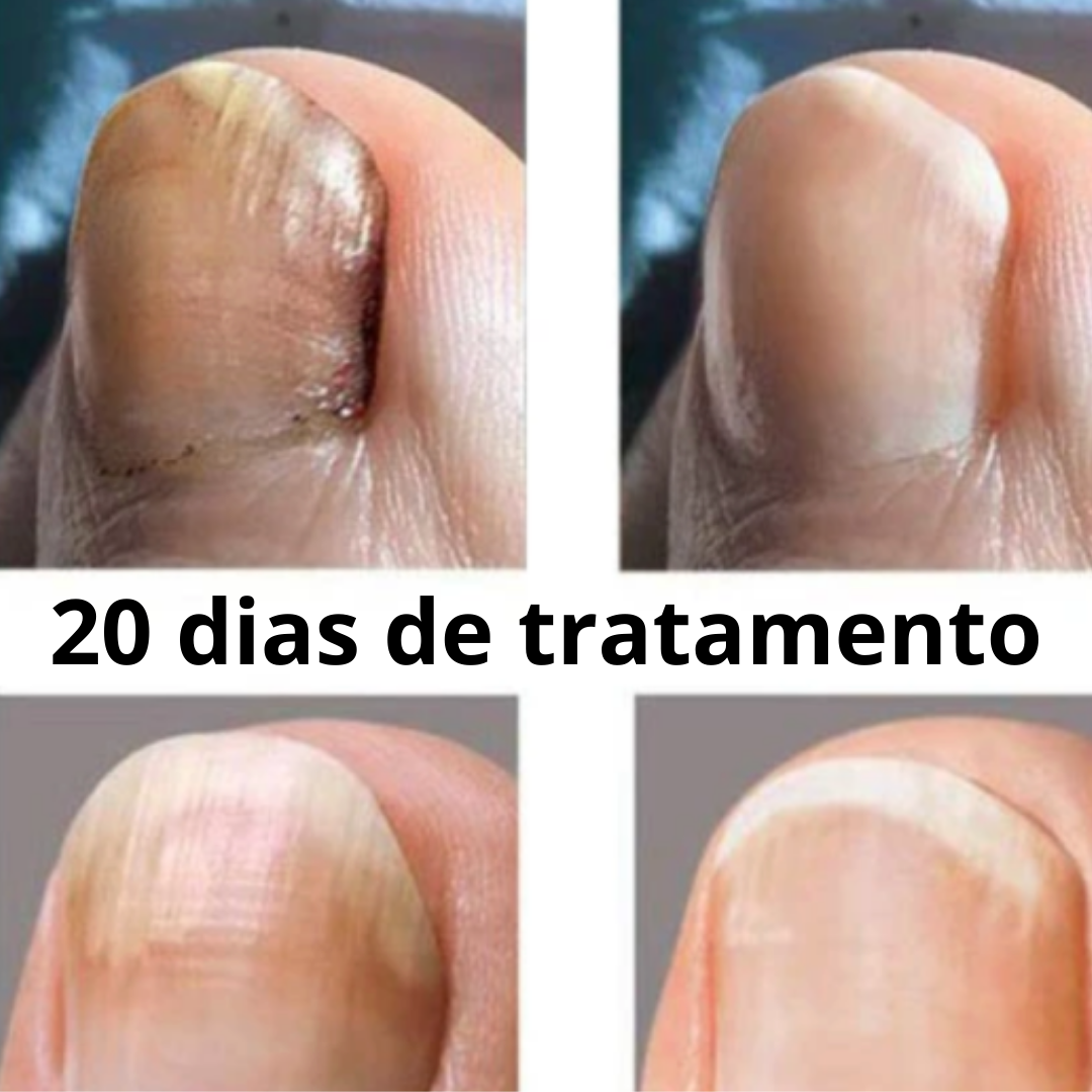 OEDO - Óleo Anti-Fungos e Micoses