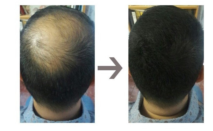 Sevich Magic Hair Fiber - Fibra Capilar Para Falhas e Calvície - Festa do Desconto