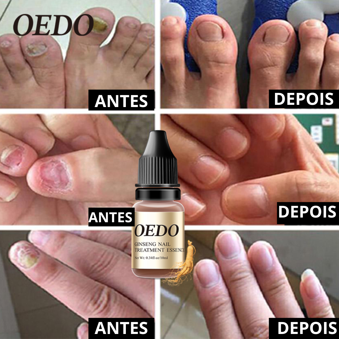 OEDO - Óleo Anti-Fungos e Micoses