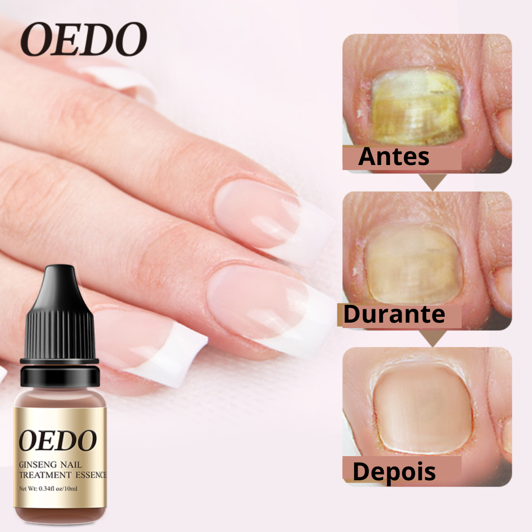 OEDO - Óleo Anti-Fungos e Micoses